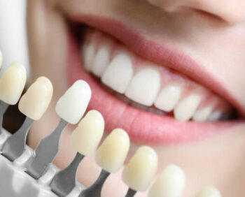 faceta-ou-lente-de-contato-dental-746x413