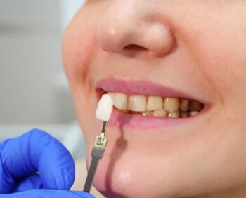 Lentes de contato dental: valor em 2021 + 6 vantagens