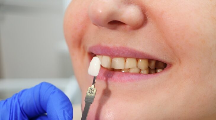 Lentes de contato dental: valor em 2021 + 6 vantagens