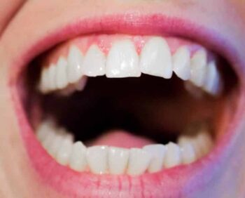 Por que os dentes voltam a entortar depois do aparelho?
