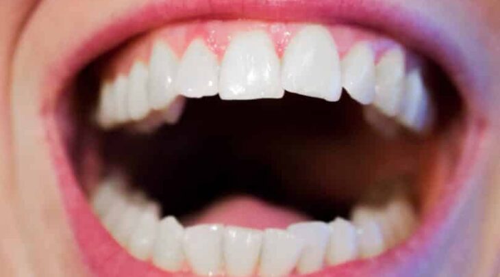 Por que os dentes voltam a entortar depois do aparelho?